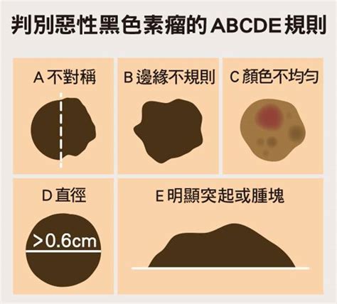 屁股長斑|皮膚斑點愈長愈多，要不要緊？